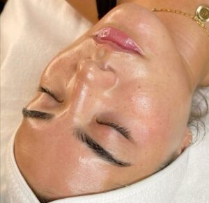 ClearLift laser treatment being performed on a client’s face at Beauty and Wellness on Olive in St. Louis, showcasing a non-invasive approach to youthful, rejuvenated skin.